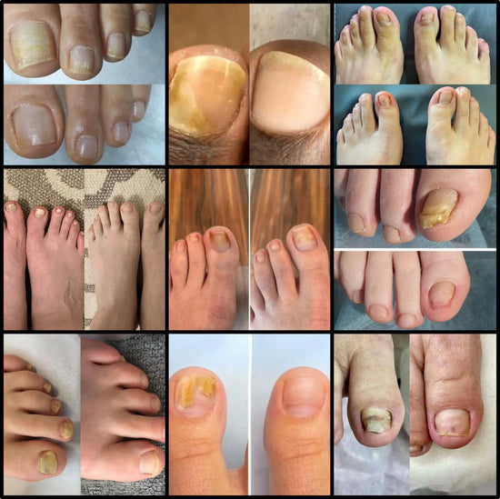 mycose ongle