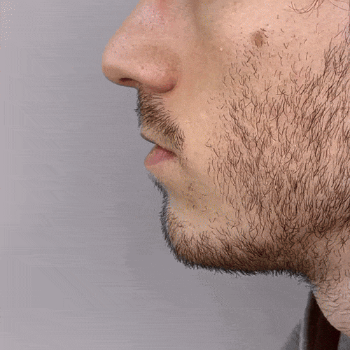 appareil rhinite et sinusite